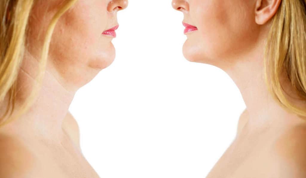 Double Chin treatment West Hendon before and after results