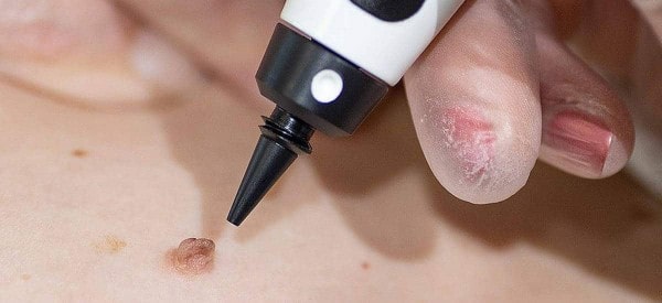 After Skin Tag Removal West Hendon
