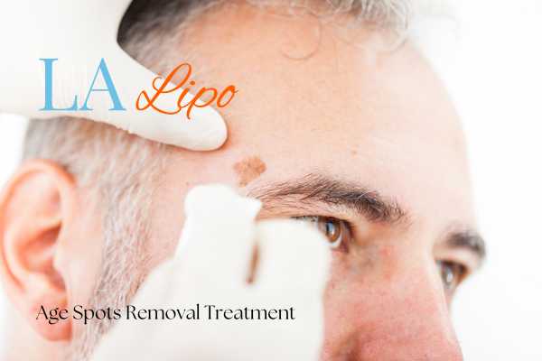 What Are the Most Effective Treatments for Age Spots West Hendon?