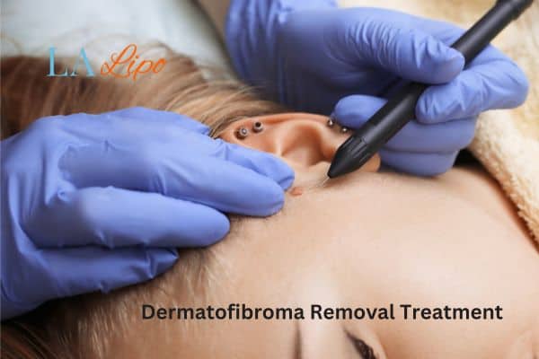 Dermatofibroma Removal Treatment West Hendon