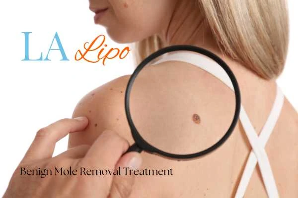 Woman having her inspection of blemish before mole removal West Hendon