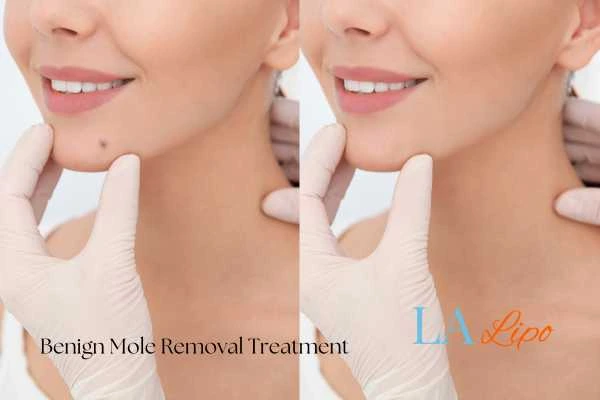 Before and after mole removal West Hendon treatment