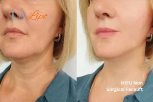 hi-fu for wrinkles West Hendon before and after results