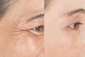 Before and after results of woman - HI-fu wrinkles reduction treatment West Hendon