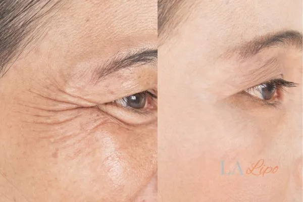 Before and after results of woman - HI-fu wrinkles reduction treatment West Hendon