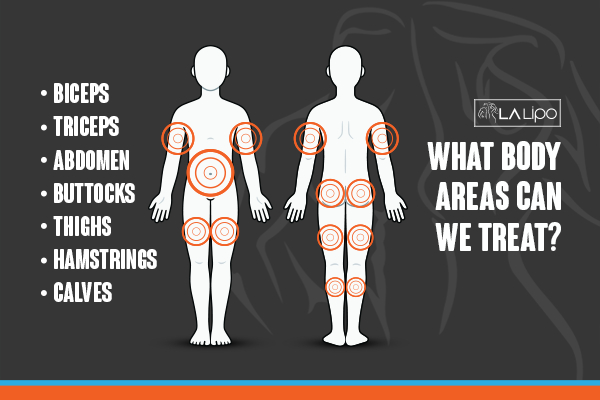 Graphic to show areas you can have LA-EMS Body Sculpting West Hendon treatment.