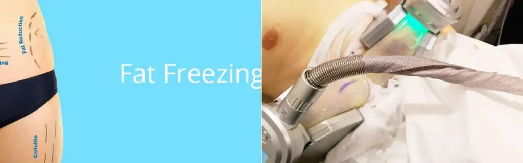 multi areas of a persons body having coolsculpting West Hendon treatment