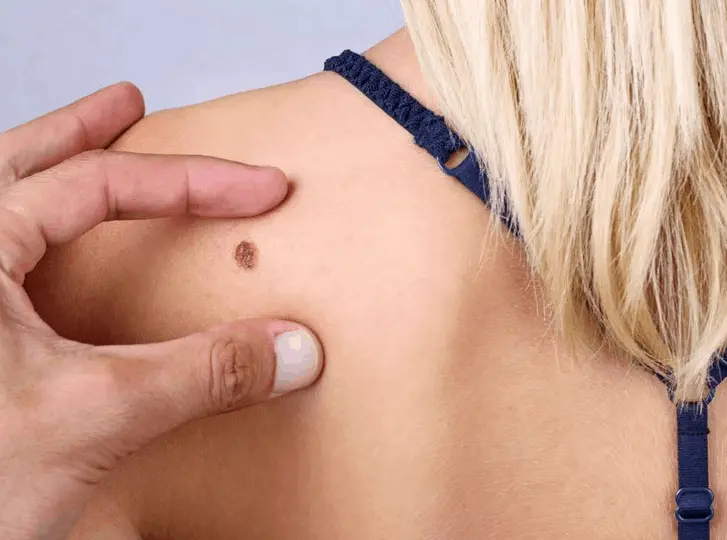 woman having mole removal West Hendon consultation before treatment.