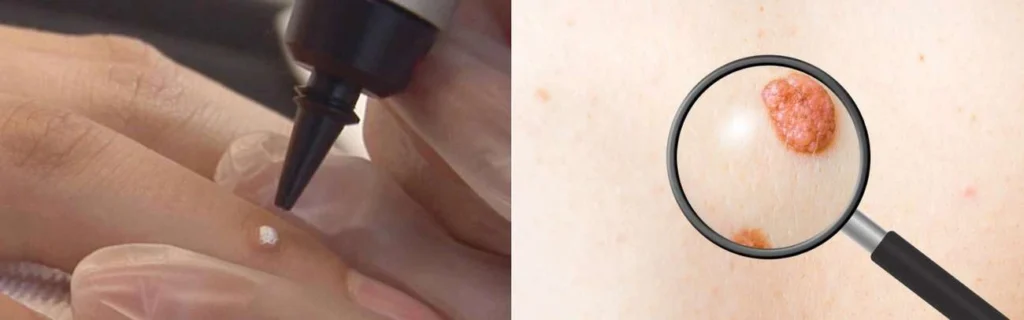 Person getting moles removed with cryopen West Hendon