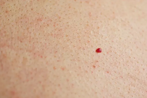 close up of a cherry angioma West Hendon