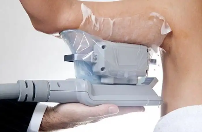 Picture of fat freezing West Hendon on the upper arms.