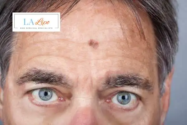 Solar Lentigo Removal West Hendon image of man with mark on his forehead