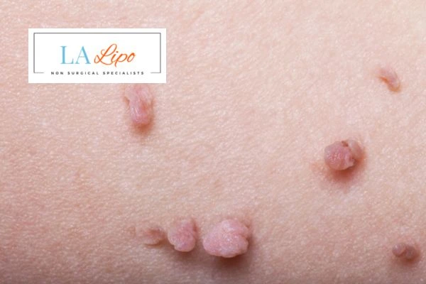 Does cryopen skin tag removal West Hendon hurt? Find out now call our team today!