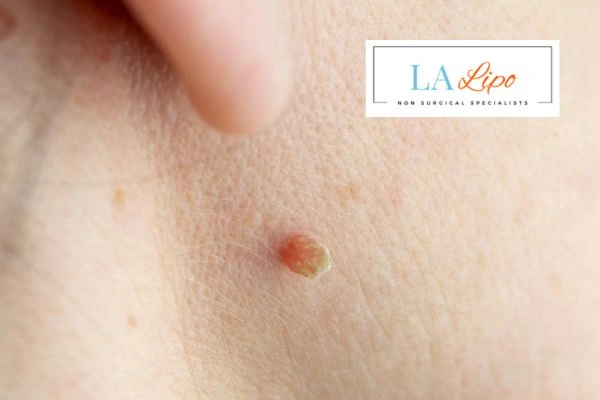 Book skin tag removal West Hendon today speak to our team now!