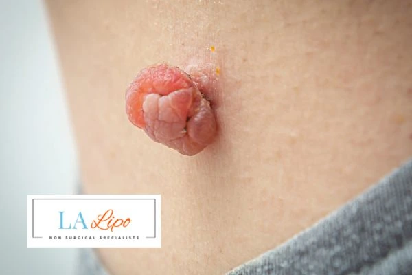Interested in skin tag removal West Hendon? Concerned about the pain? Find out more today!