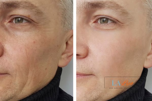 See the amazing results of Morpheus8 Treatment West Hendon!