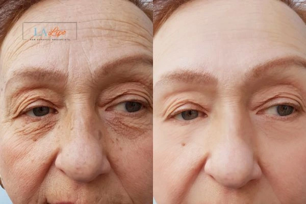 The powerful benefits of Morpheus8 Treatment West Hendon - Call Our team today!