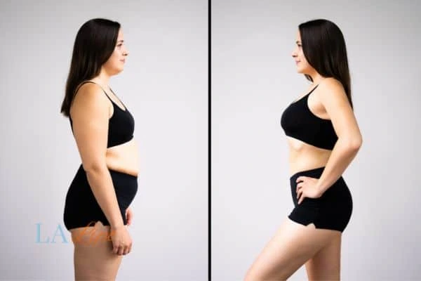 Picture of womans before and after using LA-EMS body sculpting to improve her core strength West Hendon