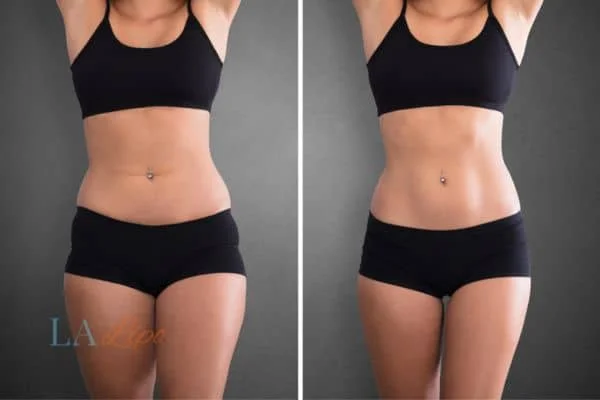 before and after results of non-surgical treatment to help a woman's body image and mental health West Hendon