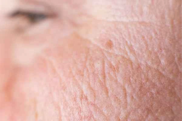 close up picture of a woman's face showing an age spot West Hendon