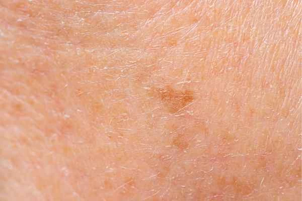 close up picture of age spots West Hendon