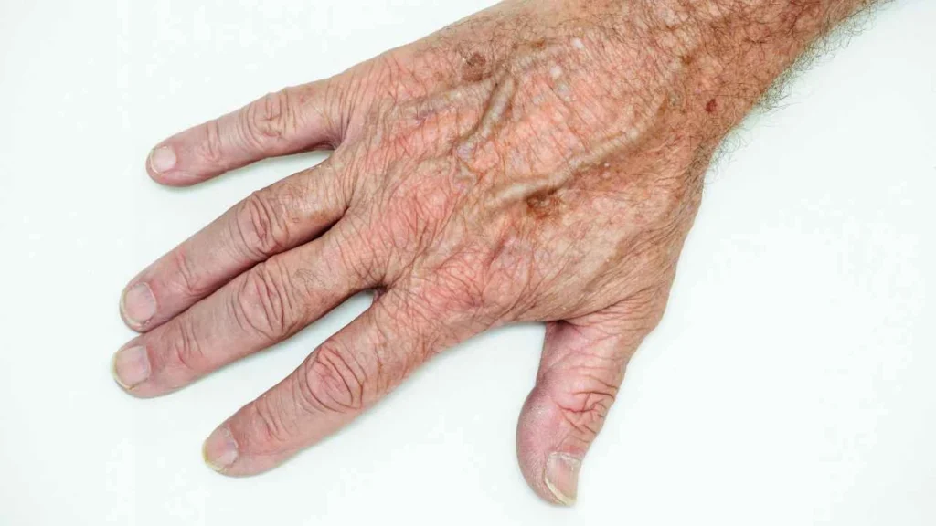 Male hand showing age spot West Hendon