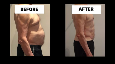 What Symptoms Can Diastasis Recti Cause in Men? Weak Core, Back Pain and Poor Posture West Hendon